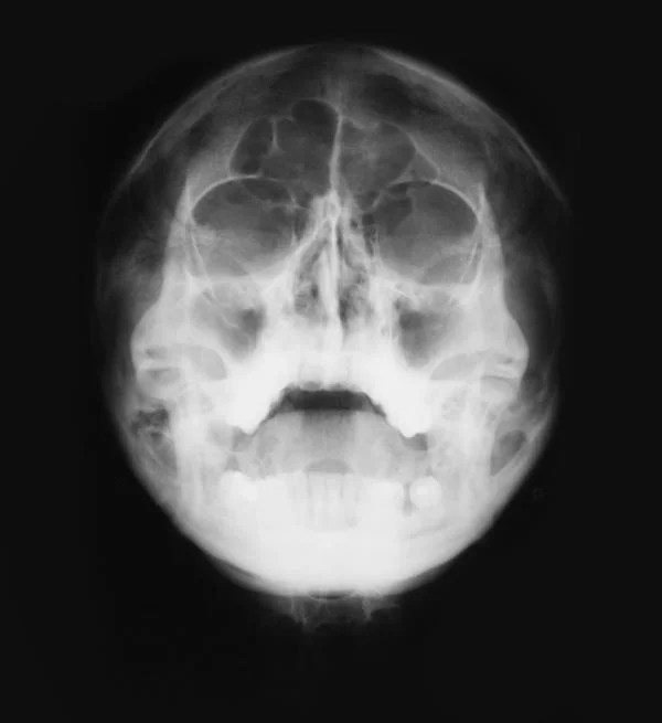 SINUS CT