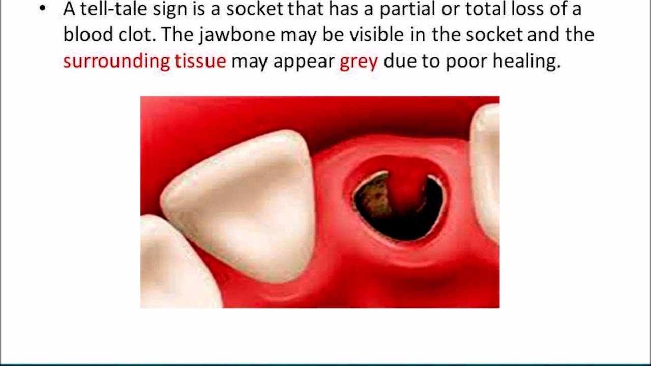 What Is Dry Socket? Buzzy Tricks