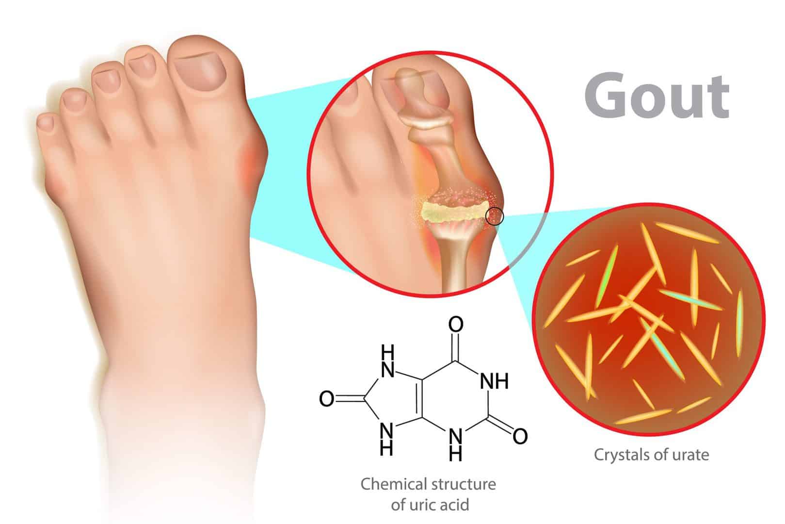 Gout Treatment & Symptoms Podiatrist near me Beaver Valley Foot Clinic