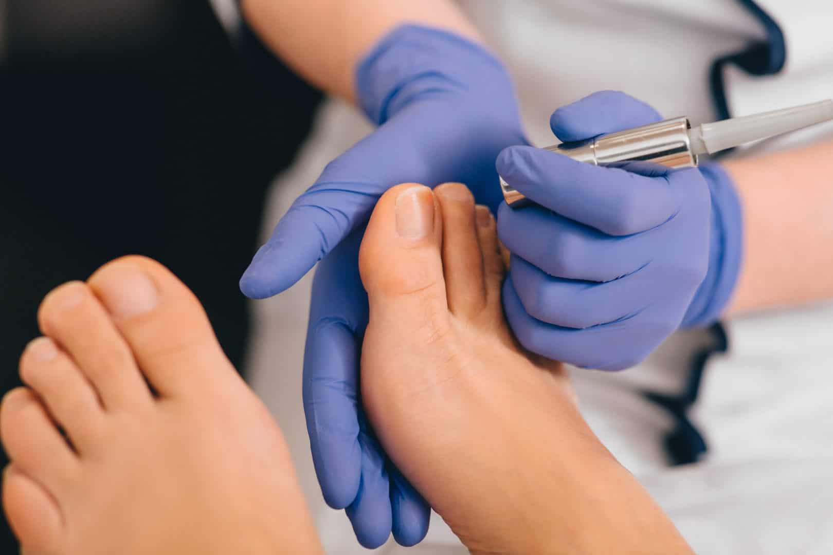 Toenail Fungus Treatment Laser Beaver Valley Foot Clinic