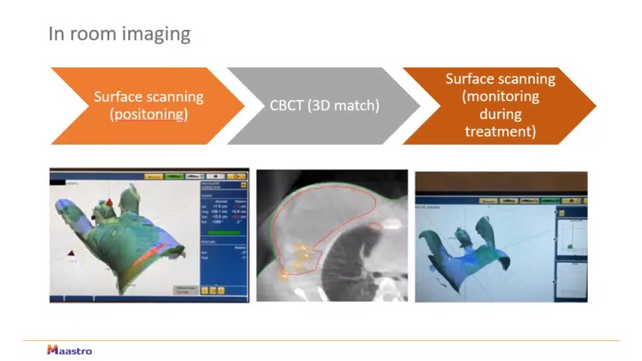 How is surface guided radiation therapy used to deliver breast cancer