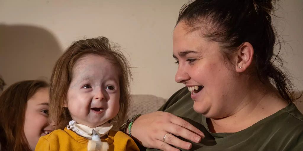 Seltene Krankheit lässt Isla (2) schnell altern