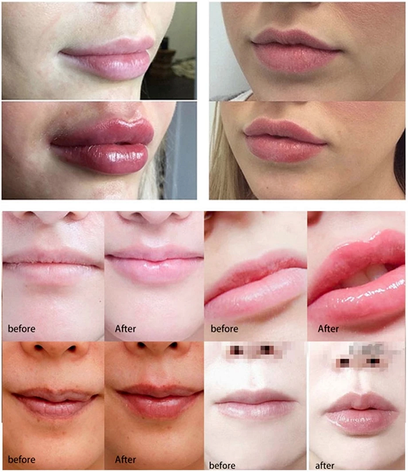 Electric Hyaluron Pen Ibeier Technology