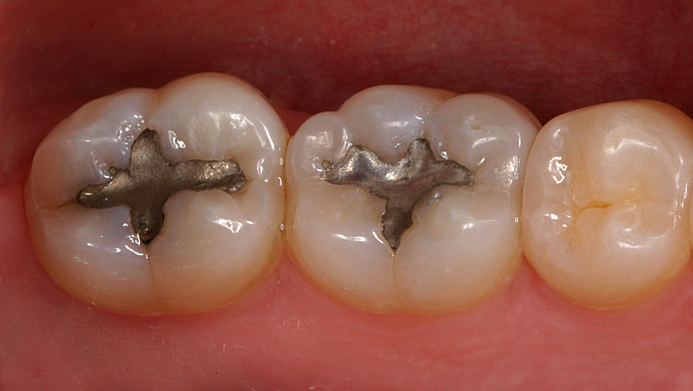 ToothColored Dental Fillings in Danville Dr. Christopher Pescatore