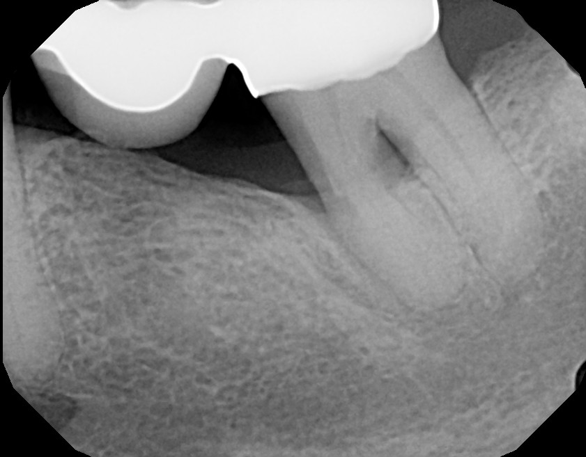 Laser Periodontal Therapy (LANAP™) Tampa, FL Tampa Bay Periodontics