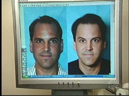 paul before + after his hair transplant with Dr. Alan Baum… Flickr
