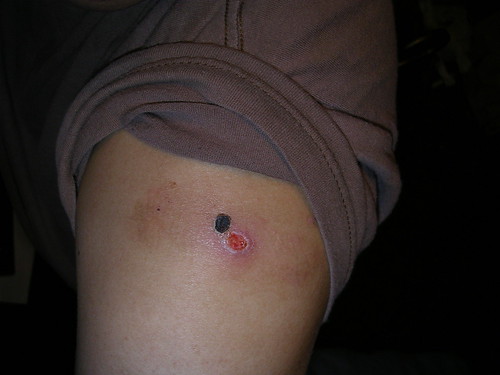 DSCN0442 my smallpox vaccine after 4 weeks, the scab