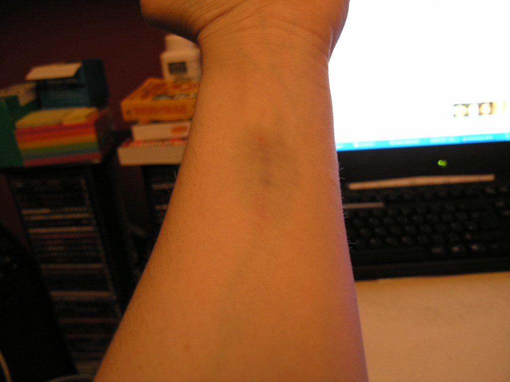 chemo bruised arm my 2nd chemotherapy left me with this