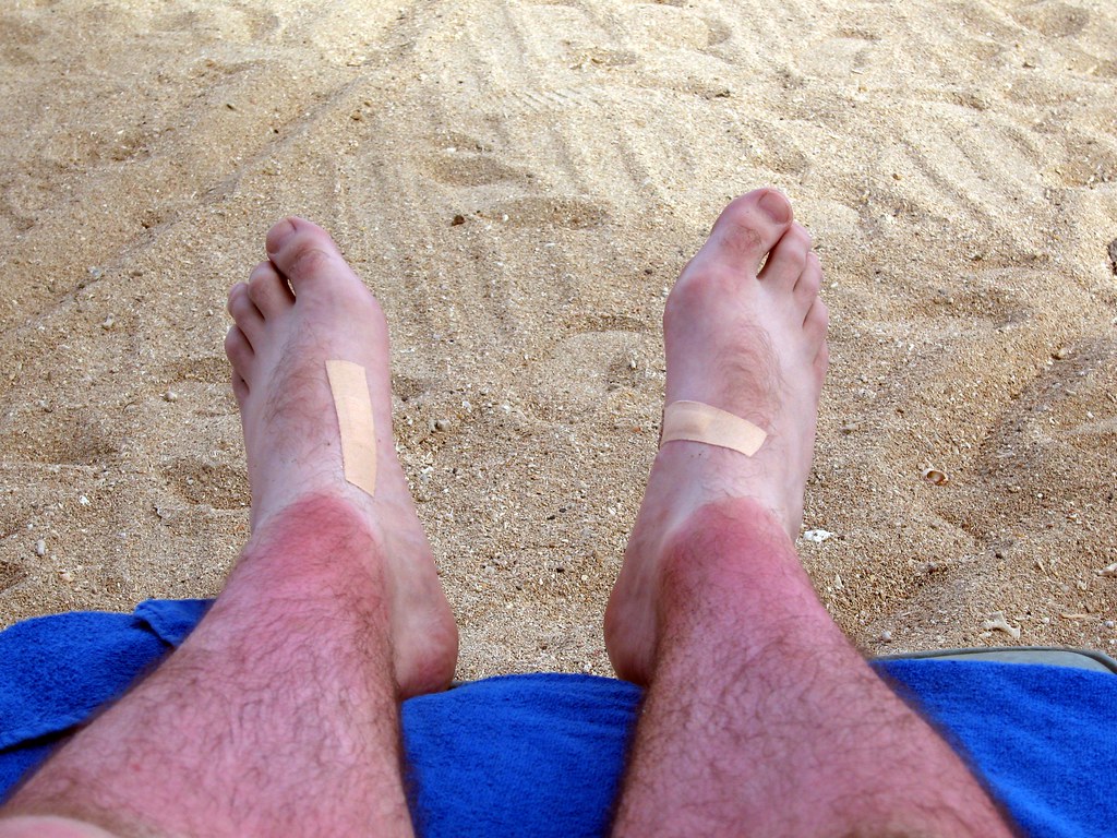 Burnt legs and blisters It's not all fun, this holiday lar… Flickr
