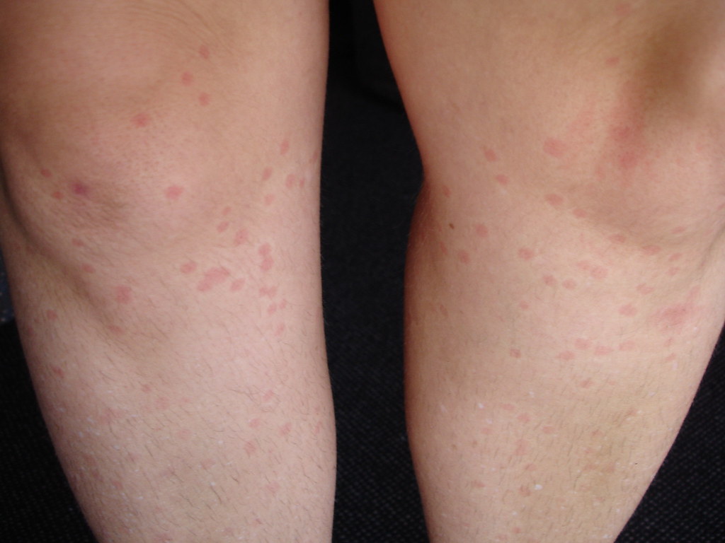 sand fly bites I would love if someone who views this mage… Flickr