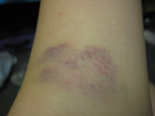 Left Arm Bruise Closeup My left arm* got nailed by an elb… Flickr