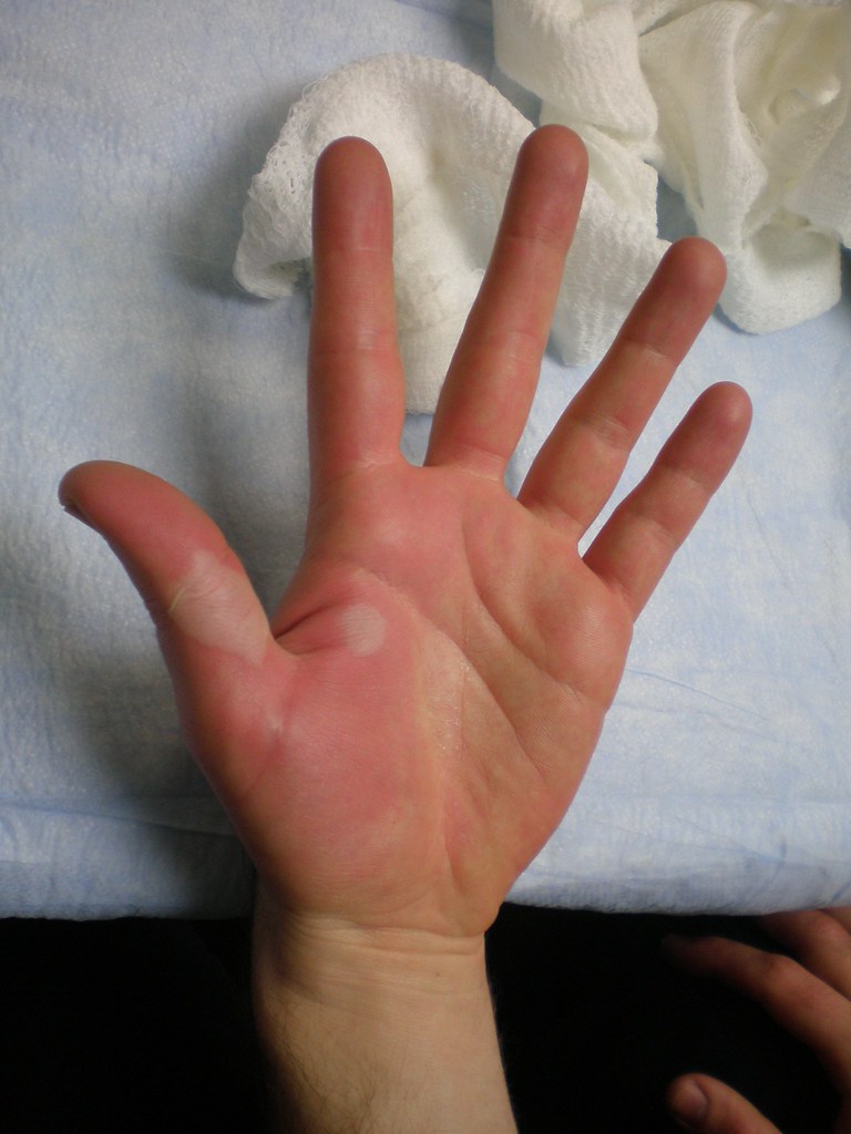burnt hand 2nd degree burns N8 Duke Flickr