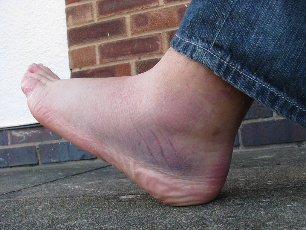 Presenting you my left foot I sustained a badass ankle spr… Flickr