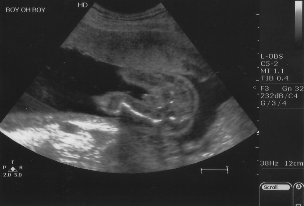 Ultrasound 22 weeks5 Ultrasound at 21 weeks, 6 days