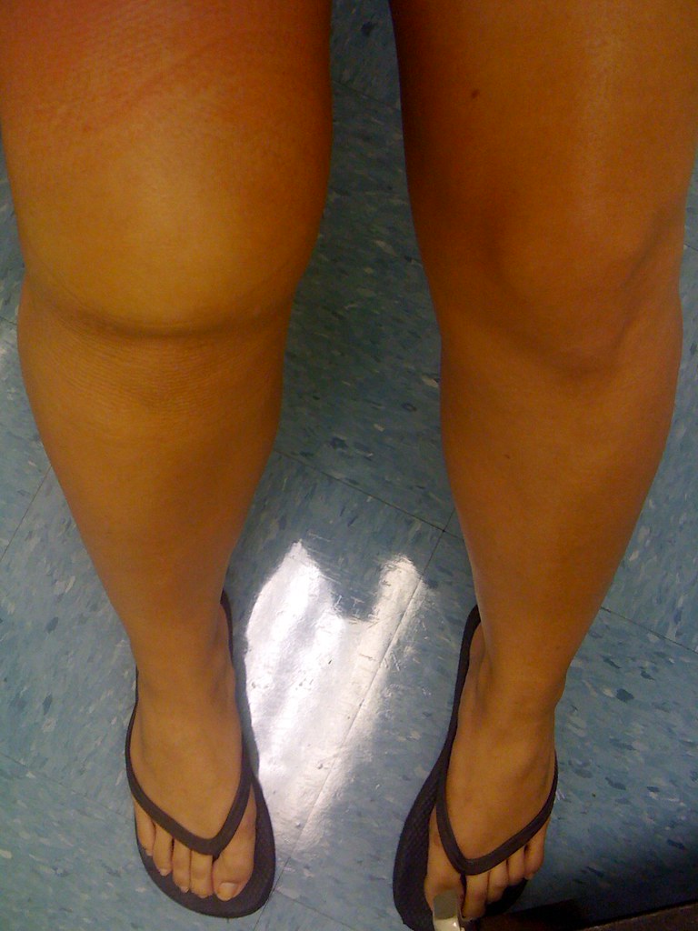 Which knee is hurt, you say? Torn quad muscles and
