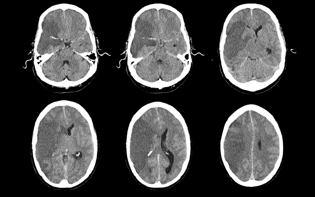 Right MCA territory brain infarct, CT (1/1) LGH_MGR_3_Radi… Flickr