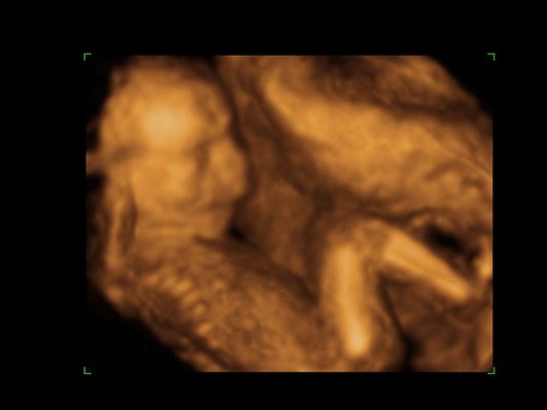 Pregnancy Ultrasound 19 weeks Photo submitted by Babies
