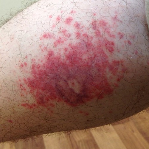 spiderbite spider bite gross nothappy gradschoolprob… Flickr