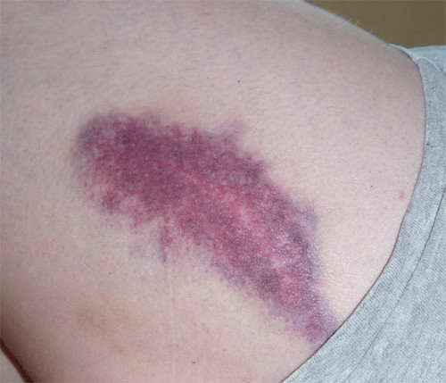 bruise on my left leg... during a craft show yesterday, af… Flickr