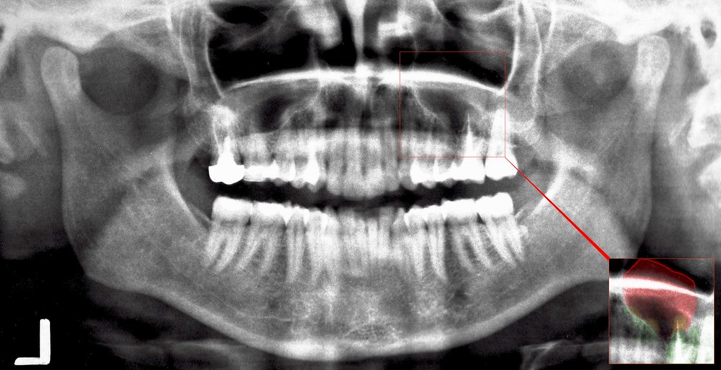 cyst on 16 tooth / root, extending into sinus maxillaris Flickr