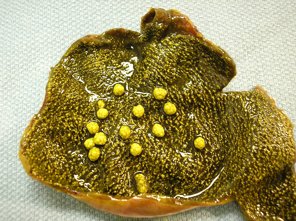 Qiao's Pathology Strawberry Gallbladder with Cholesterol … Flickr