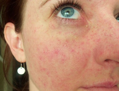 petechiae. (tiny ruptured capillaries that result from bar… Flickr
