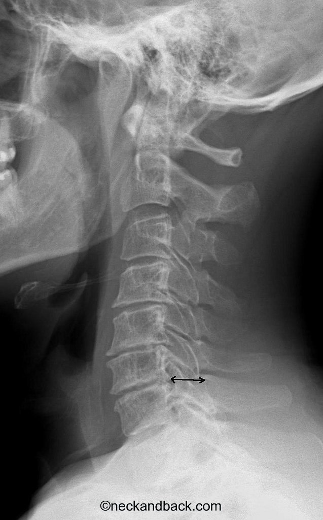 XRay of Cervical Spine Spinal Cord Compression Donald… Flickr