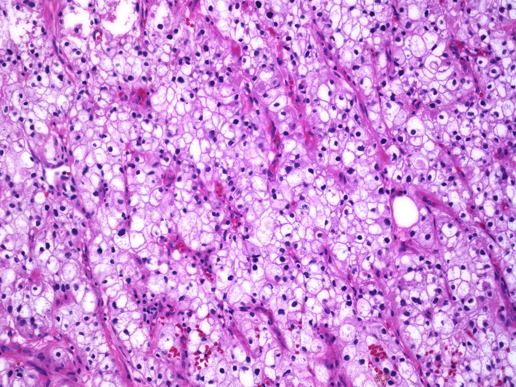 Urothelial Carcinoma, Clear Cell Type (Glycogenrich) Flickr
