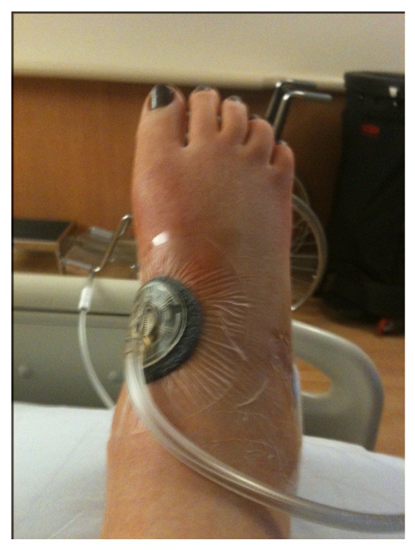 Ankle Fusion Surgery Flickr
