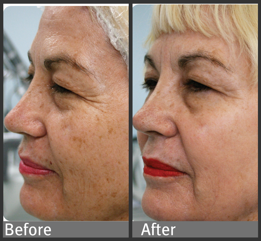 Ipl Face Treatment Before After Doctor Heck