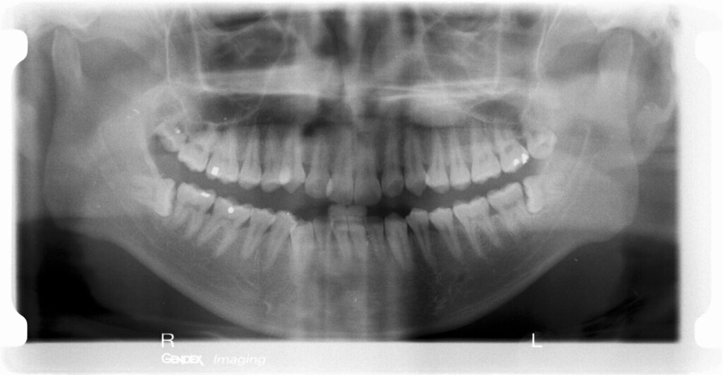 Xray scan of my mouth Taken by the dentist for inspecting… Flickr