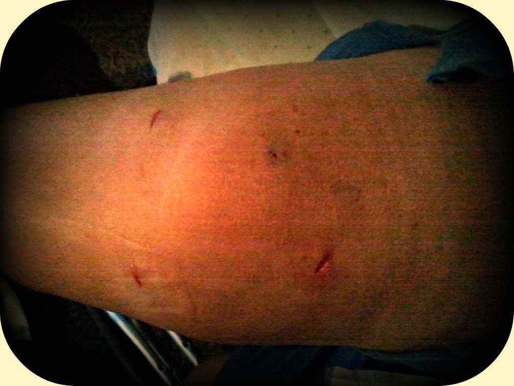 Pain 1 Year After a Knee Replacement – Is This Normal?