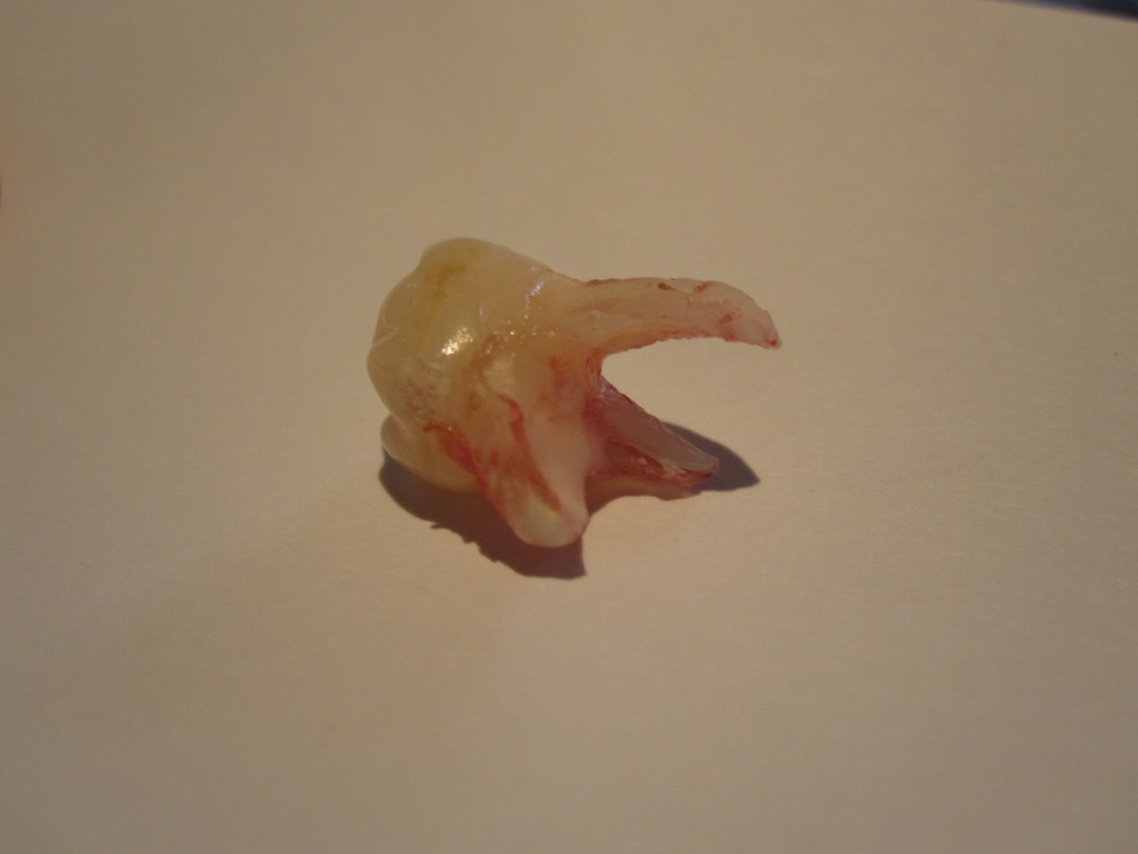 Pulled tooth Max had severe tooth pain this morning