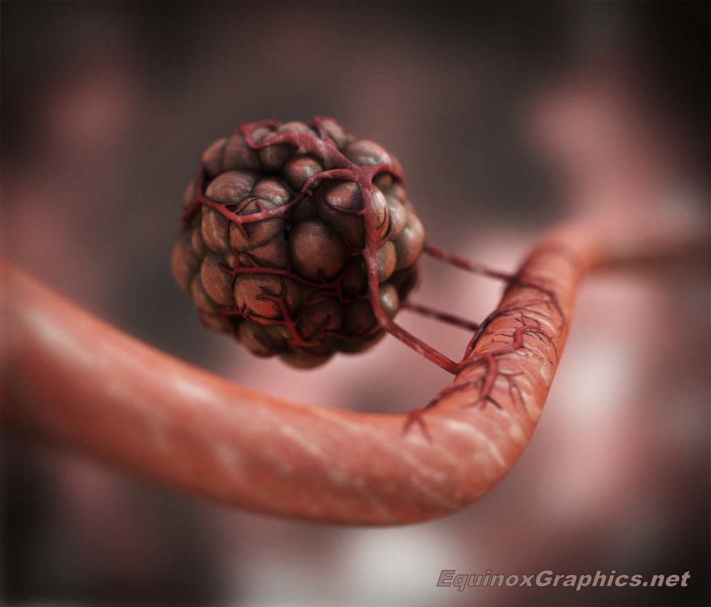 Tumordriven Angiogenesis A illustration of the