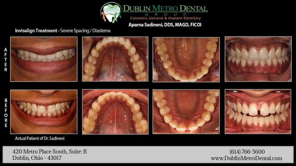 Severe Spacing/Diastema Invisalign Treatment If teeth ar… Flickr