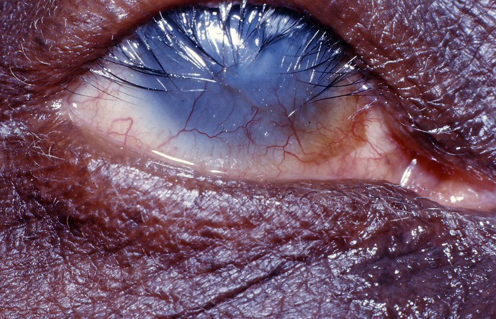 Corneal blindness, with extensive vascularization due to s… Flickr