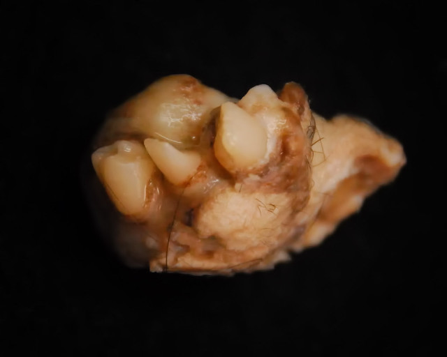 Ovarian Dermoid Cyst with well formed teeth Flickr
