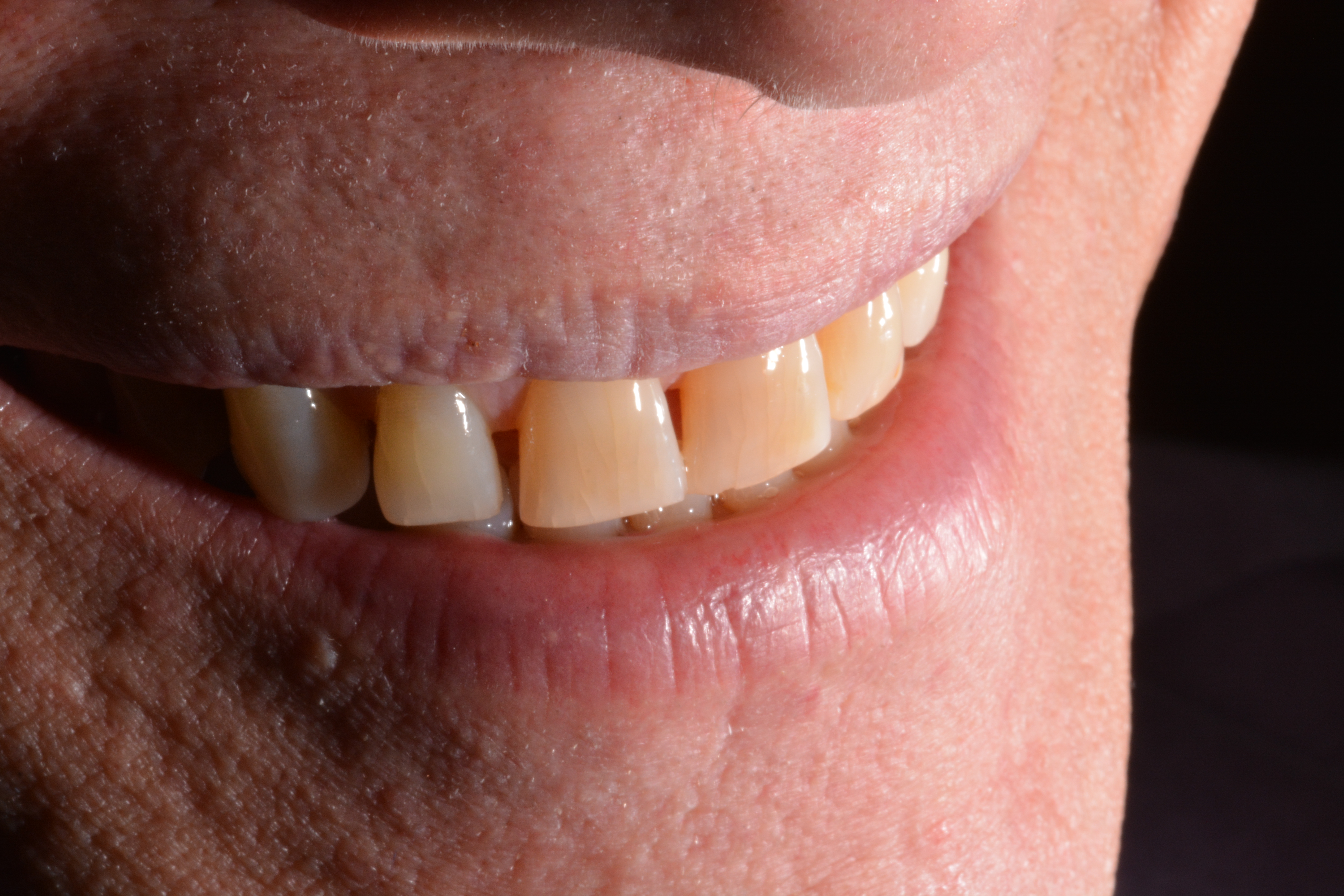How To Fix Gaps In Teeth – These 7 Best Non-Painful.