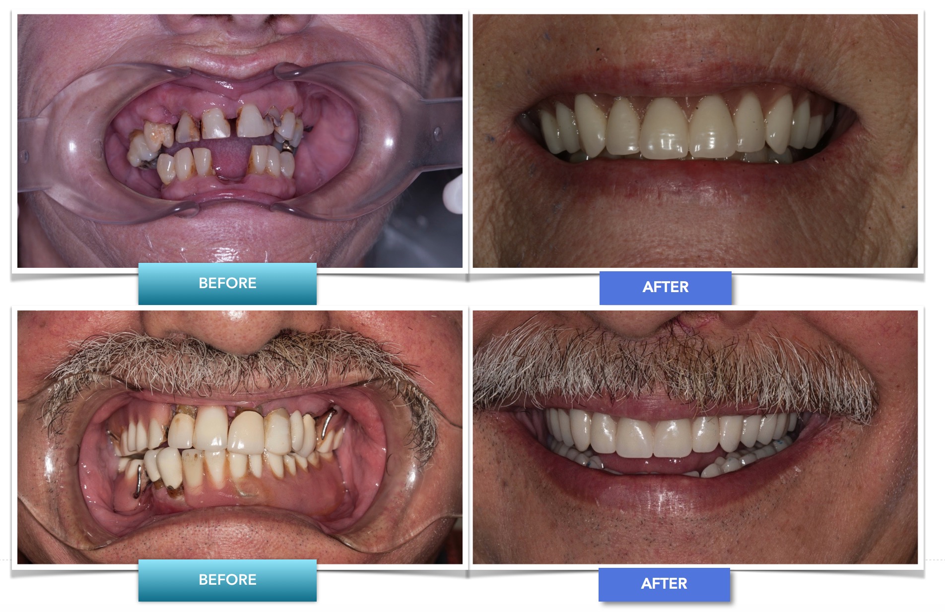How Much For All New Teeth TeethWalls