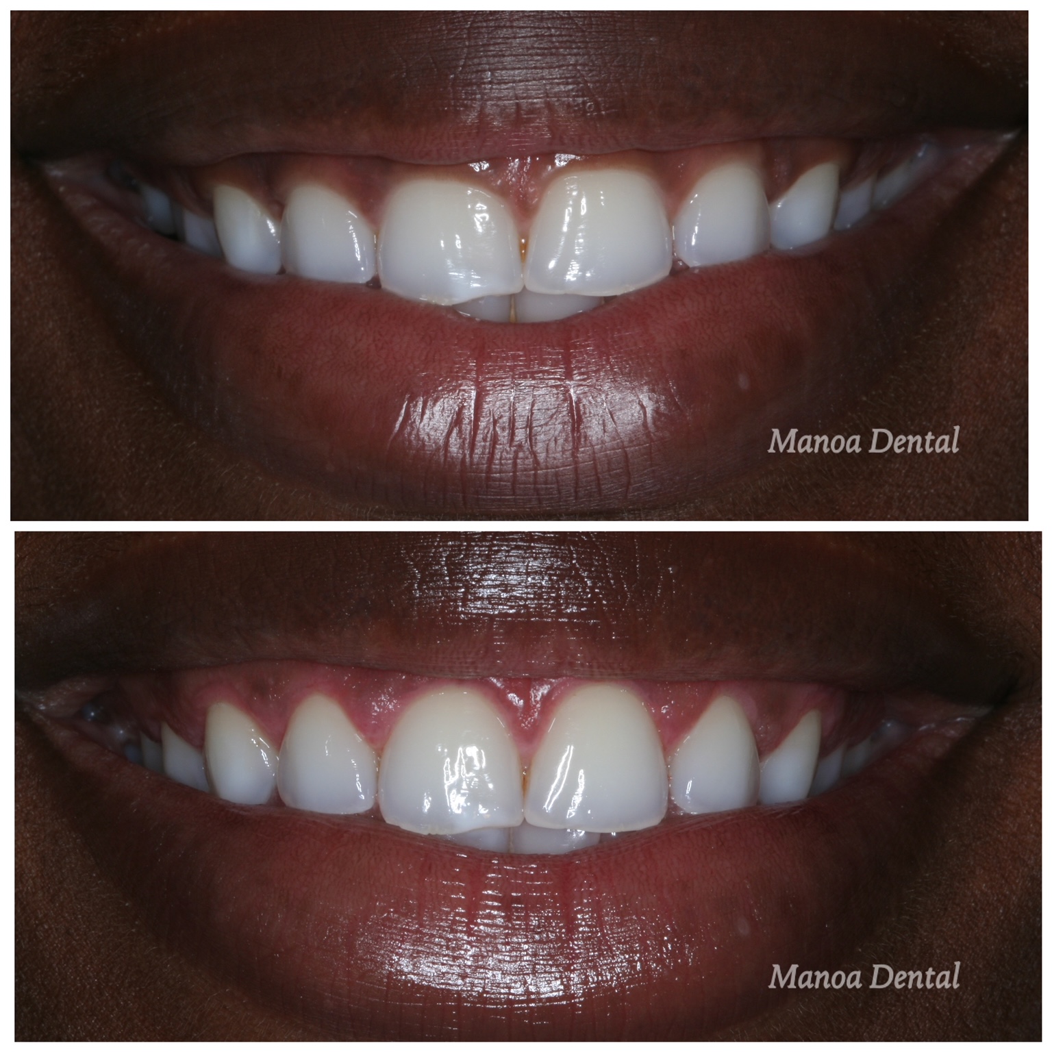 Honolulu HI Gum Lift Honolulu Gum Graft Manoa Dental