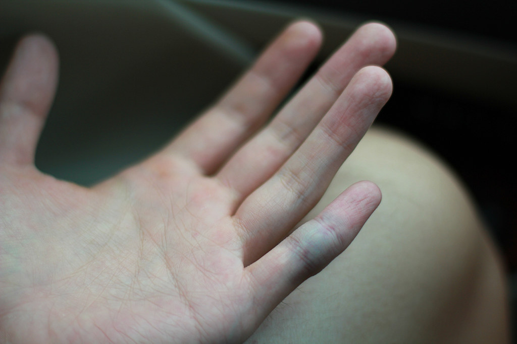 6092010 pinky finger is swollen RYAN Flickr