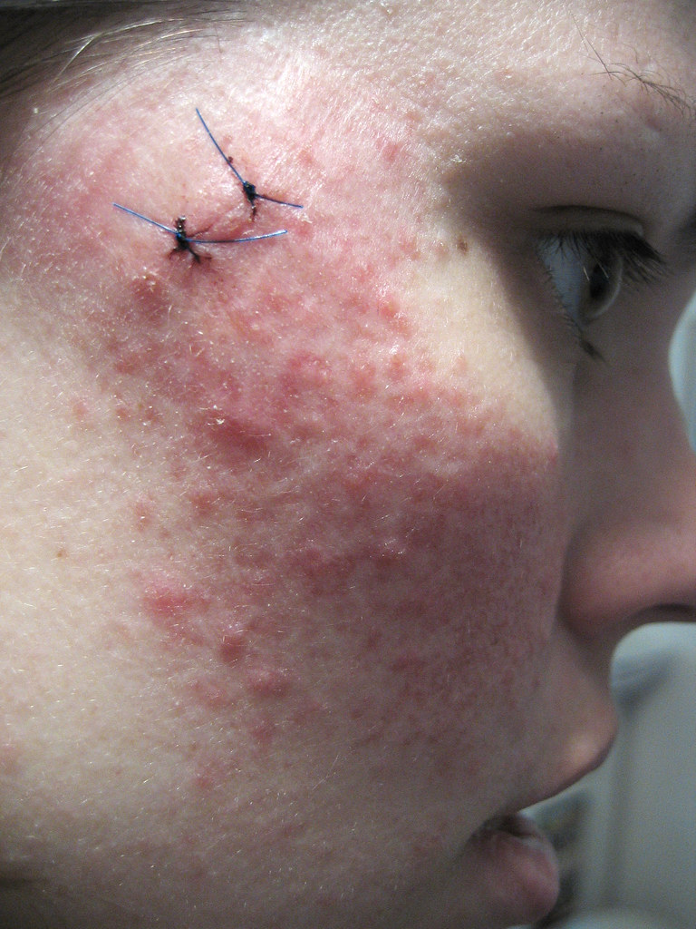 skin biopsies Stitches for the punch biopsies I had Mrs Jackson