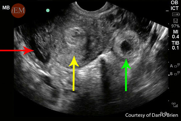 Figure 4 Ectopic Small Fluid Pseudogestational sac Flickr