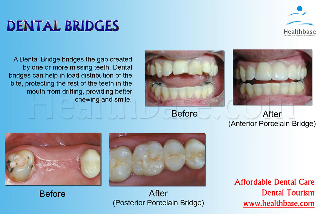 Dental Bridges For affordable Dental Bridges procedure log… Flickr