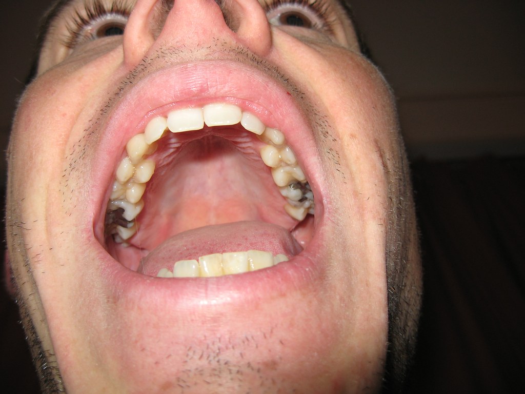 upper jaw with silver fillings Old silver amalgam fillings… Flickr