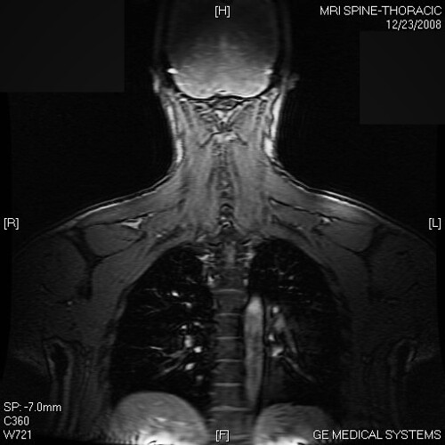 Back Thoracic MRI A shot of back muscle and a peek into … Flickr