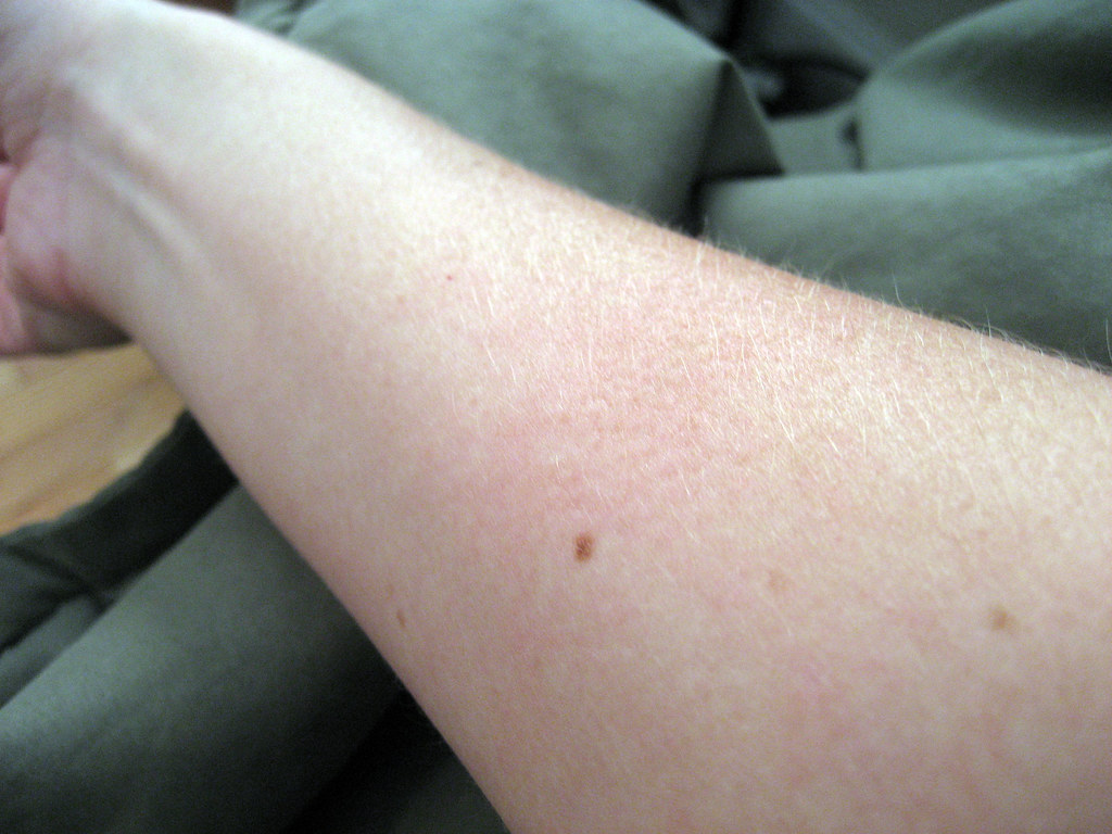 rash from saddleback caterpillar sting tammyleino Flickr