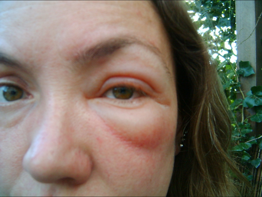 Bee sting swelling after 24 hours kaslgd