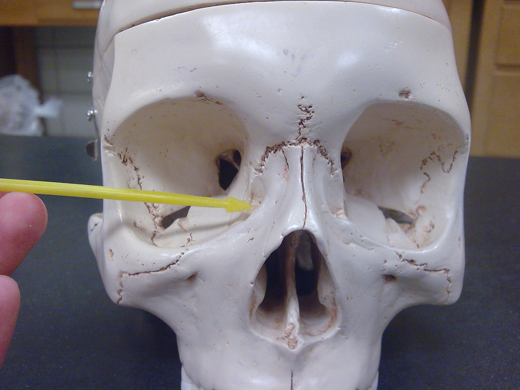 Lacrimal Bone indention or groovelike structure above