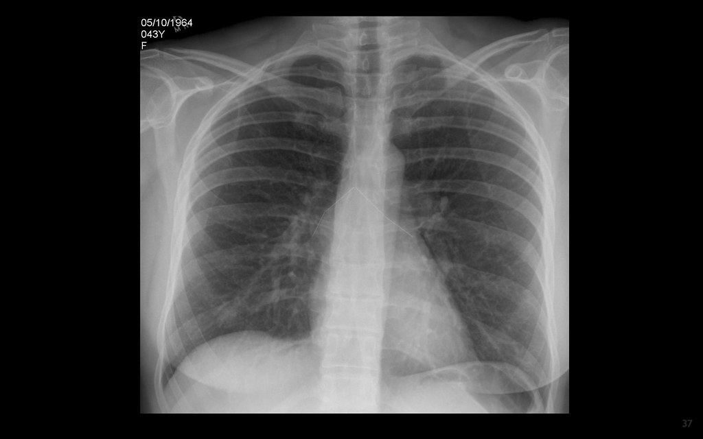 "Intermittent chest pain and dyspnoea on lying down. Any p… Flickr